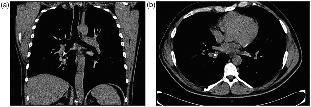 HRCT (coronal) six months before the operation showing the traffic cone occluding the right bronchus intermedius HRCT (coronal) six months before the operation showing the traffic cone occluding the right bronchus intermedius
